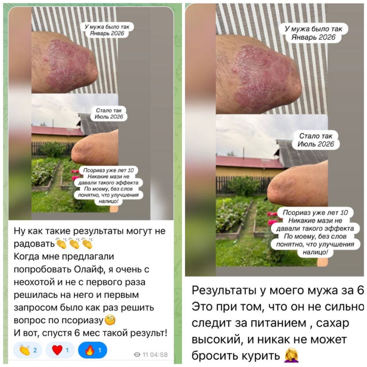 улучшение при псориазе